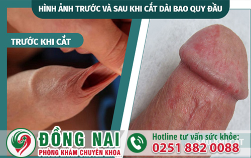 Hình ảnh cắt bao quy đầu dài