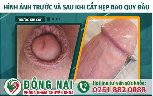 Hình ảnh cắt bao quy đầu hẹp