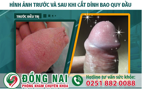 Hình ảnh cắt bao quy đầu bị dính